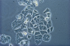 Breast cancer cells.