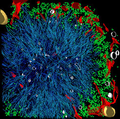 Huntingtin aggregates (blue) form large inclusion bodies that deform the membrane of the endoplasmic reticulum (red). Numerous ribosomes (green) are found at the periphery of the aggregates.