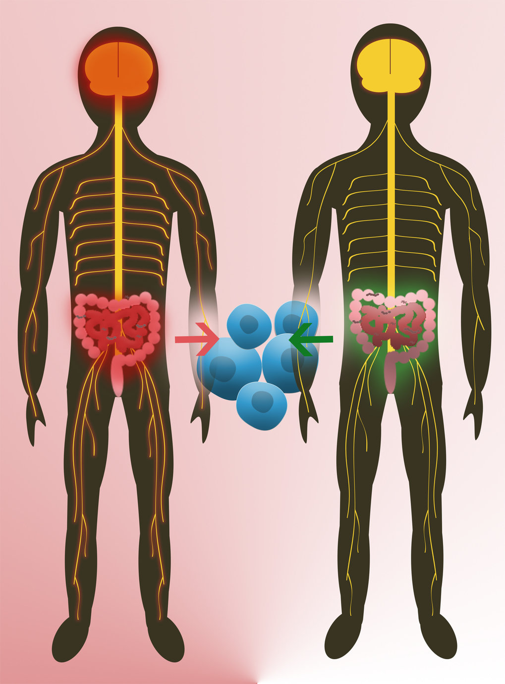 Studies on twins reveal: the natural intestinal flora can trigger Multiples Sclerosis (left). T-cells (blue) play a central role.
