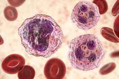 Noticeable changes in the number and ratio between the different types of blood cells is a sign of leukemia.