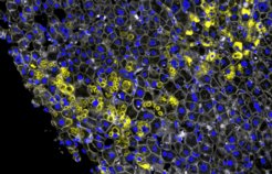 Mikroskopische Aufnahme einer menschlichen Leberbiopsie. Alpha-1 Aggregate in gelb, Leberzellen in grau mit blauem Zellkern.